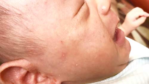 最新版 赤ちゃんの体にぶつぶつできた原因 乳児湿疹の予防と治し方 ママシャブログ